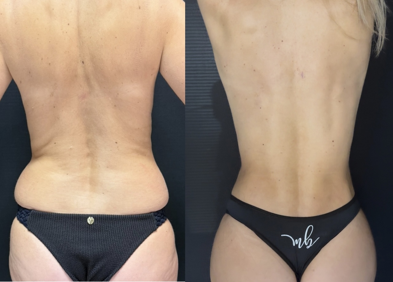 Contorno corporal posterior com flancos refinados