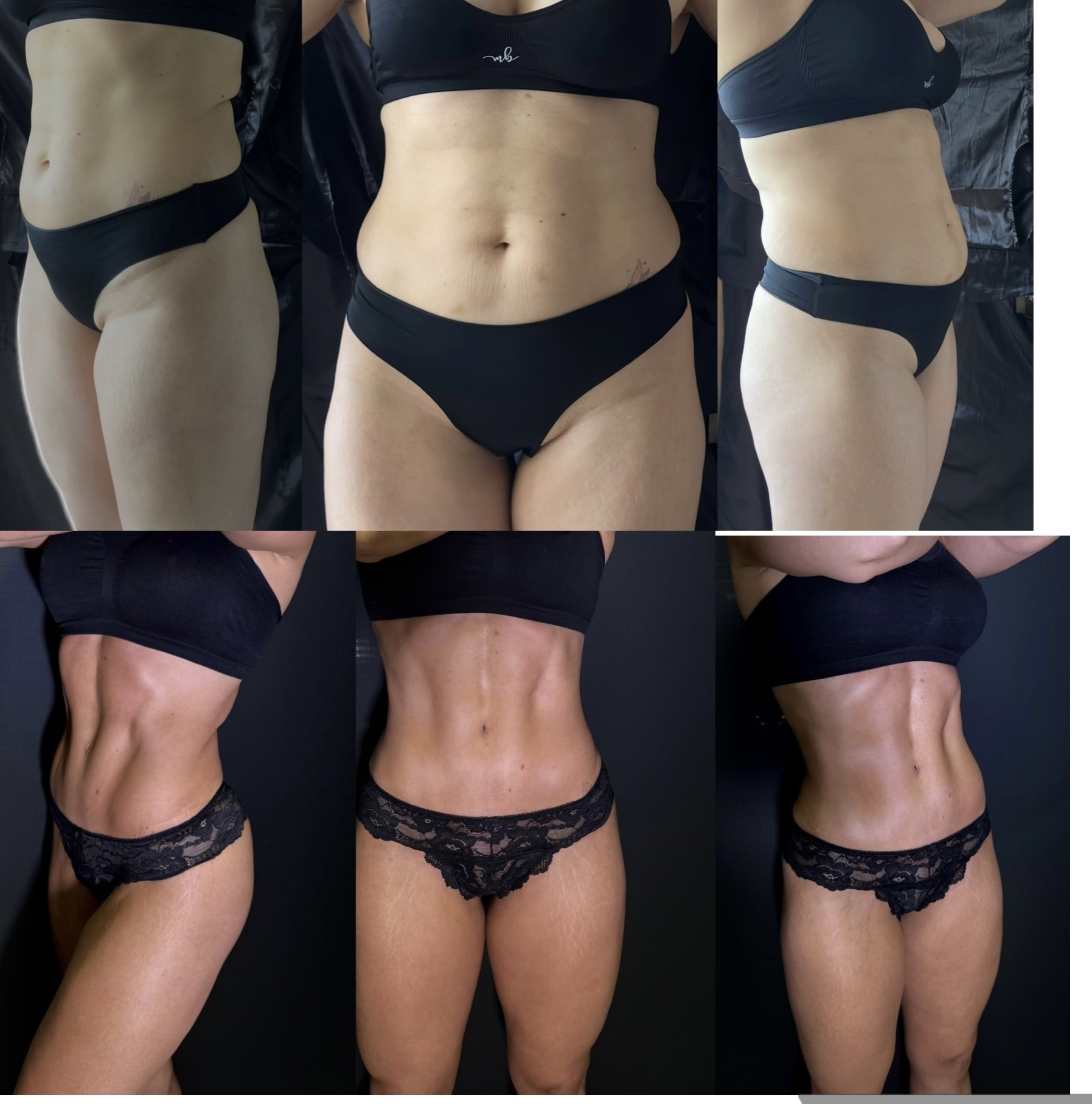 Lipoaspiração Ultra HD com definição abdominal avançada