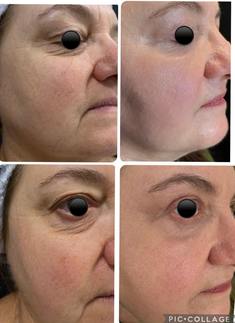 Resultado de laser de CO2 fracionado para rejuvenescimento cutâneo