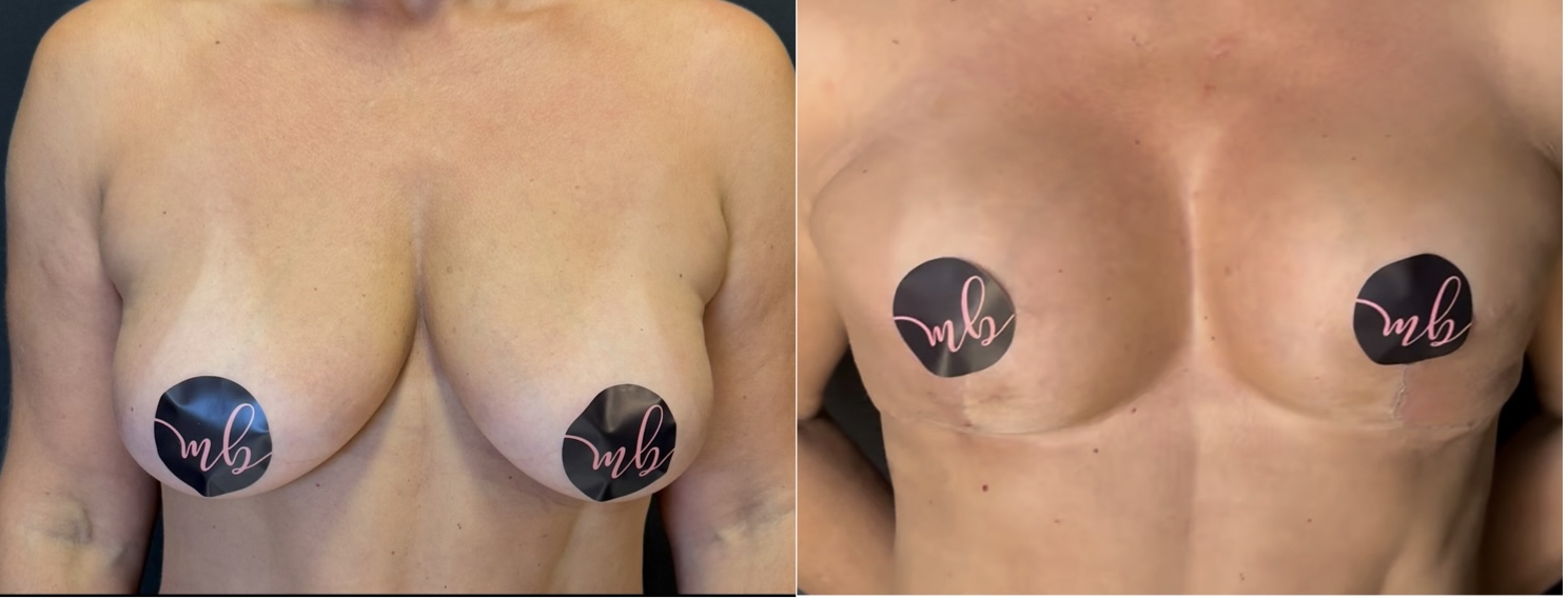 Resultado de mamoplastia com cicatriz reduzida e contorno natural