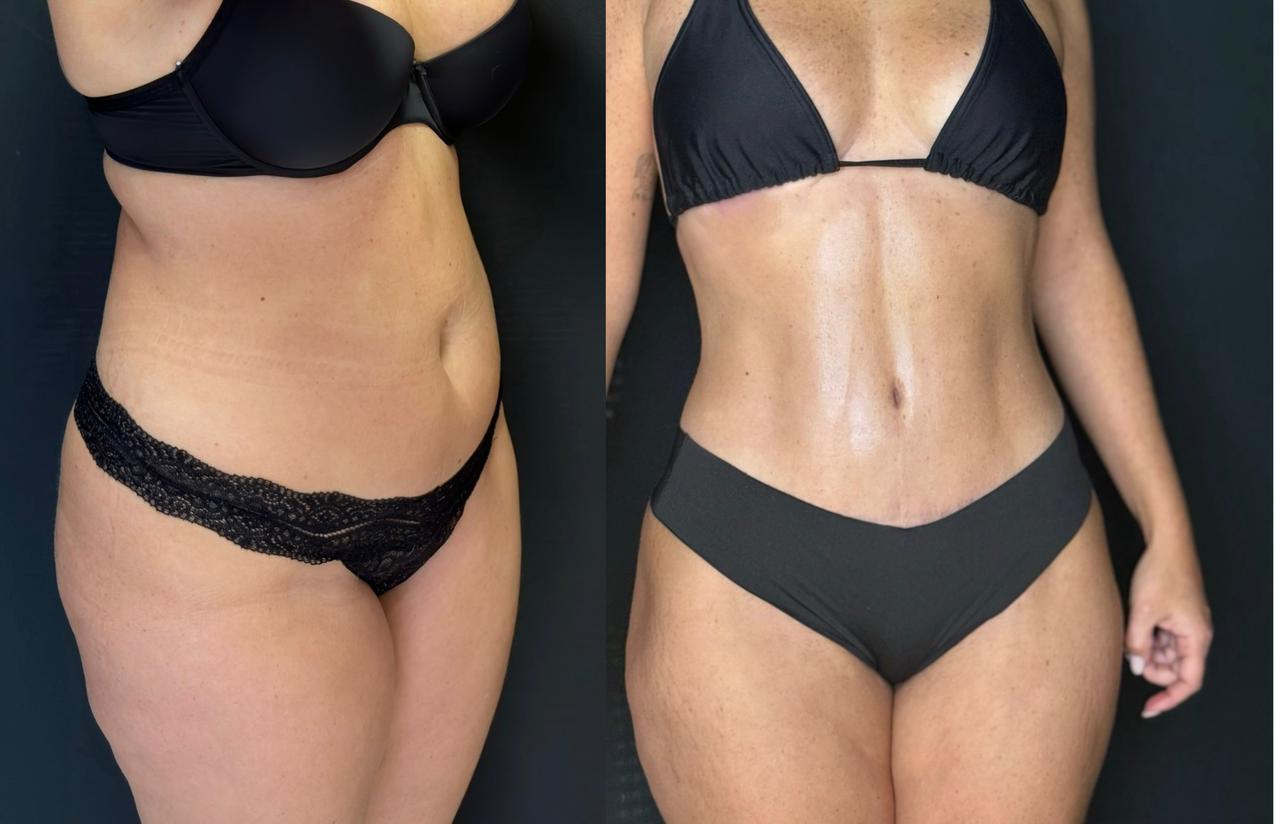 Resultado de lipoabdominoplastia HD raft com definição abdominal